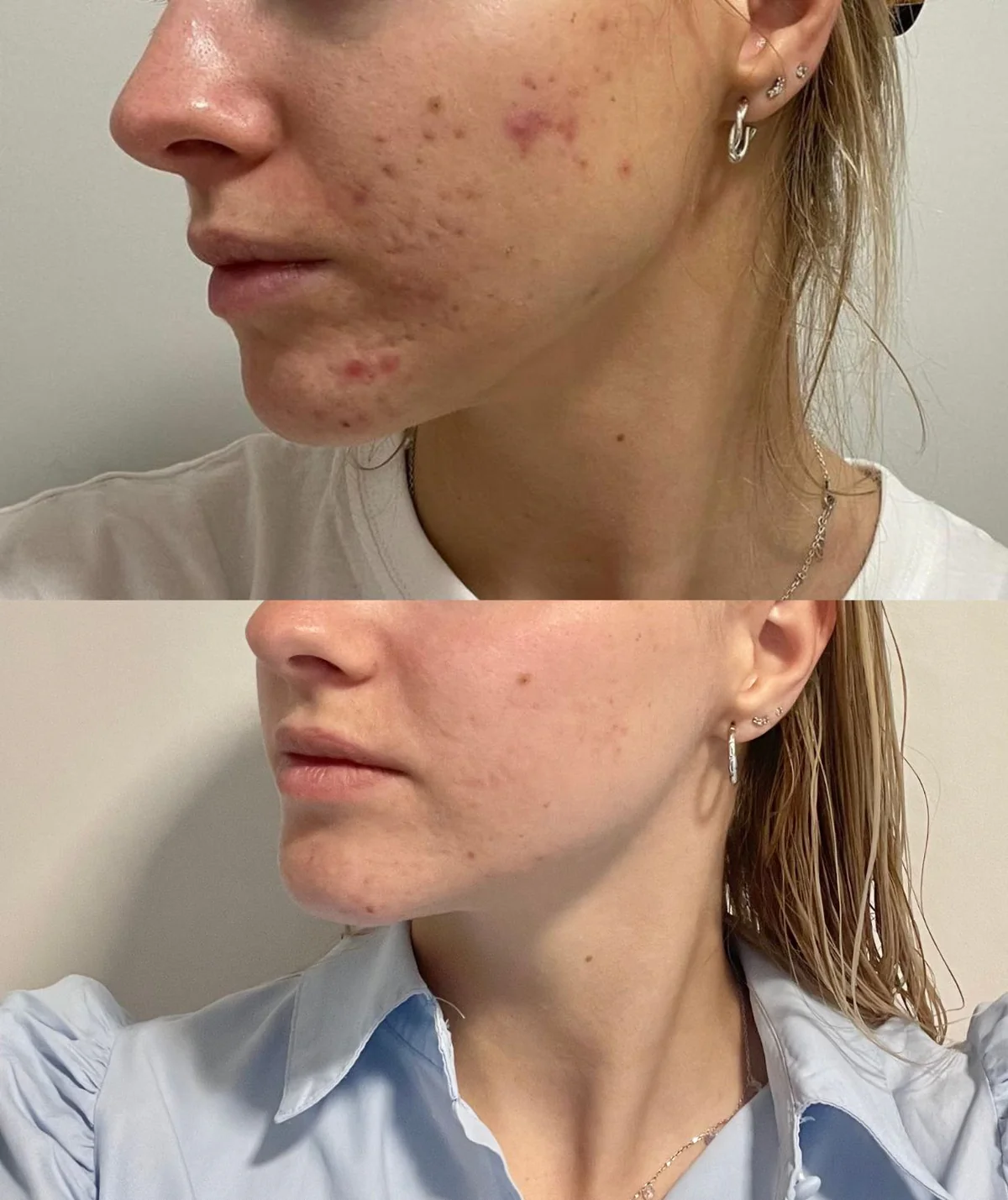Sérum pour peau à tendance acnéique Ray