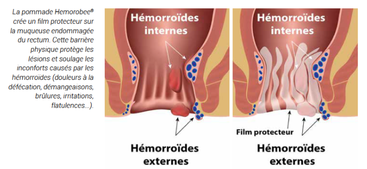 Hémorroïdes externes